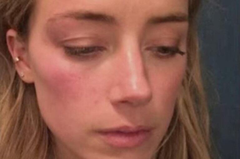 Amber Heard’ün kavga sonrası yaralı fotoğraflarının fotoşop olduğu iddia edildi￼
